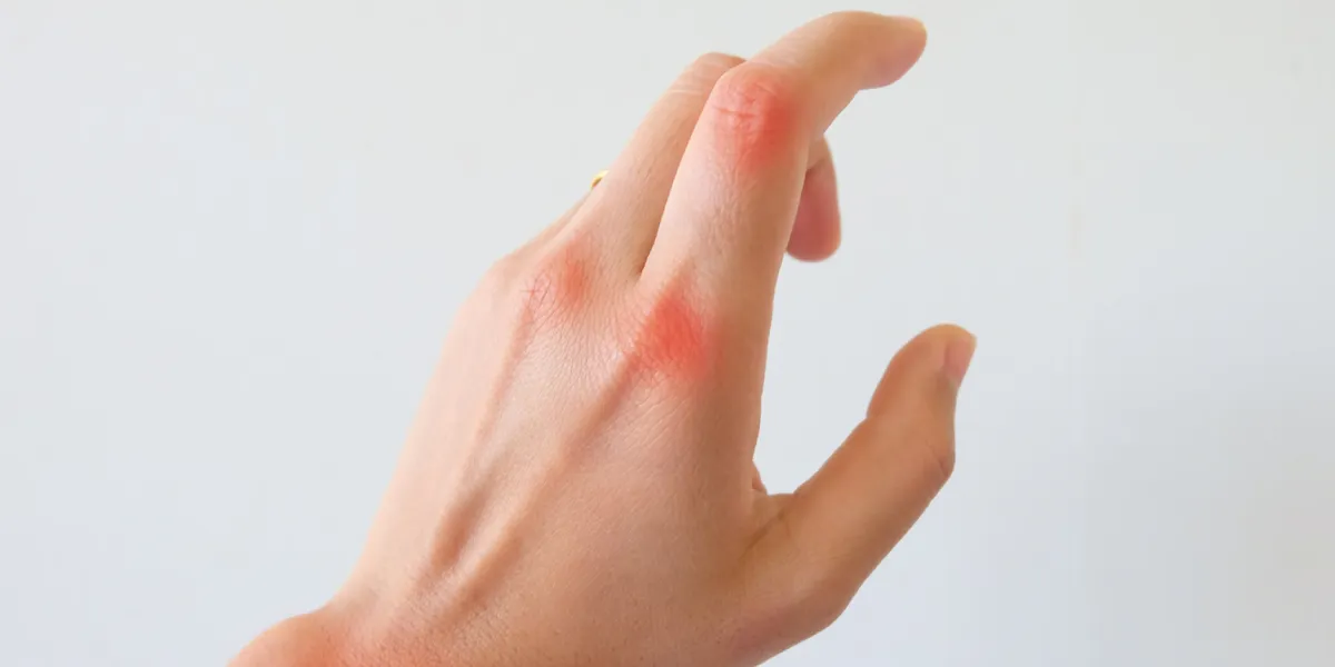How to Cure Rheumatoid Arthritis Permanently?