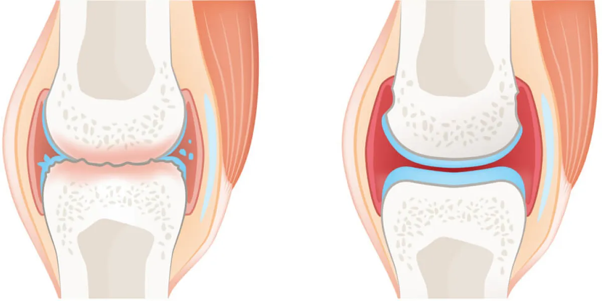 How Do I Know if My Joint Pain Is Rheumatoid Arthritis?