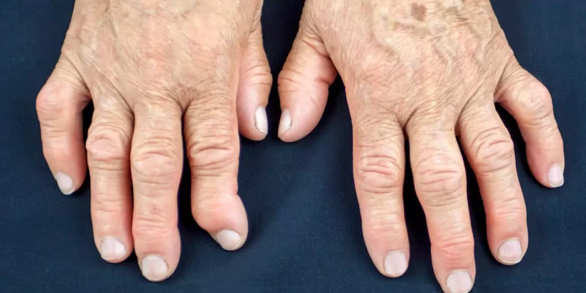 Arthritis? Now what?