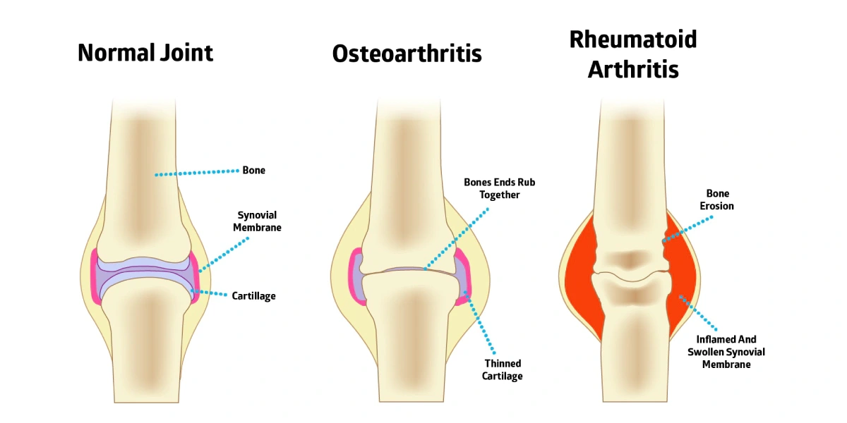 What are the Symptoms That Show My Joint Pain is Coming from Arthritis?